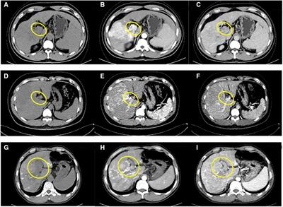 Case Report: Combining liver partition and portal vein ligation after thrombectomy for tumor isolation (CLAPT) to treat advanced hepatocellular carcinoma with portal vein tumor thrombosis